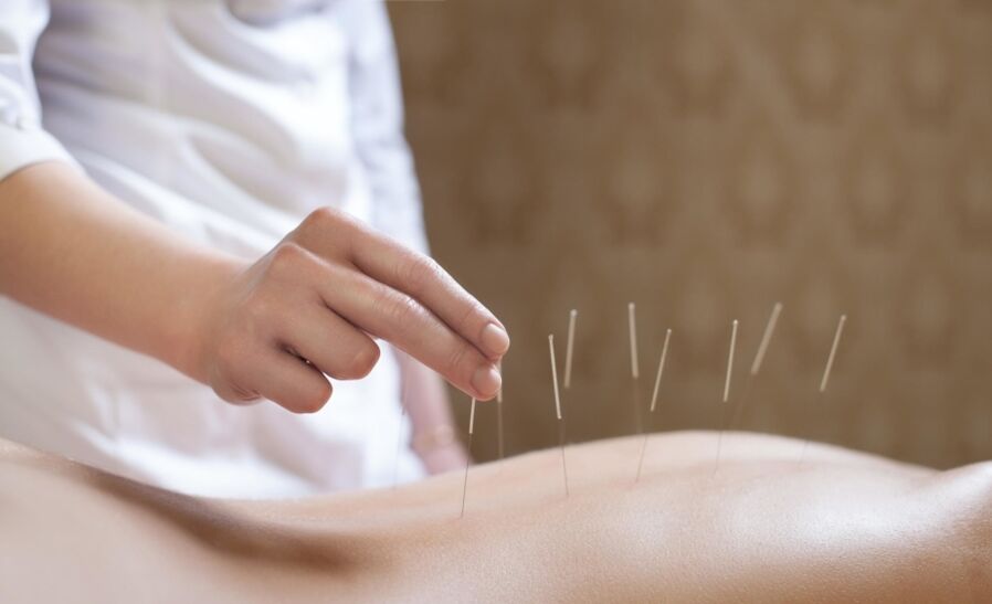 acupuncture